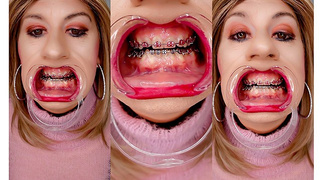 Braces bizarre! See Alexandra Braces with an open mouth expander